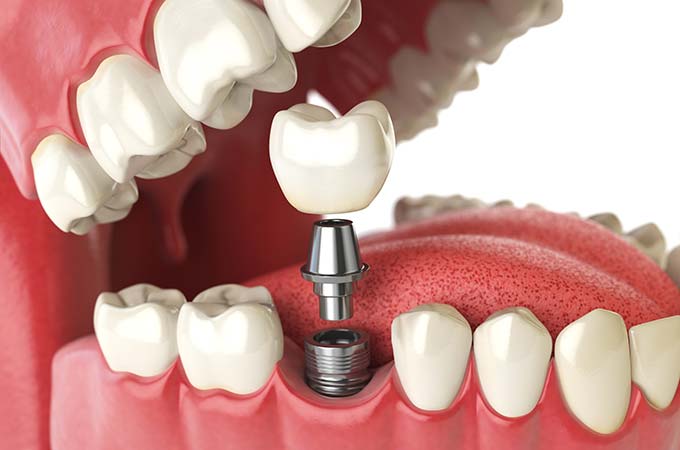 Cat rezista un implant dentar
